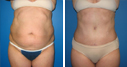 Before & After Photos